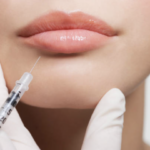 Juvederm Volbella